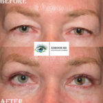 Upper Eyelid Bleph