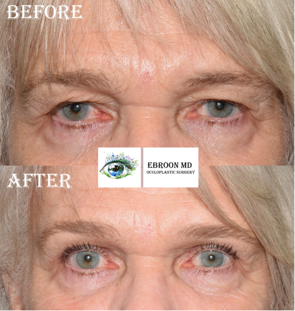 Brow lift Photo Brow lift Photo