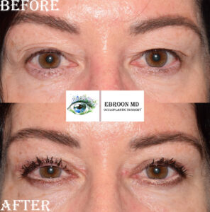 Upper Blepharoplasty Photo