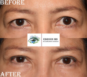 Upper Blepharoplasty Photo