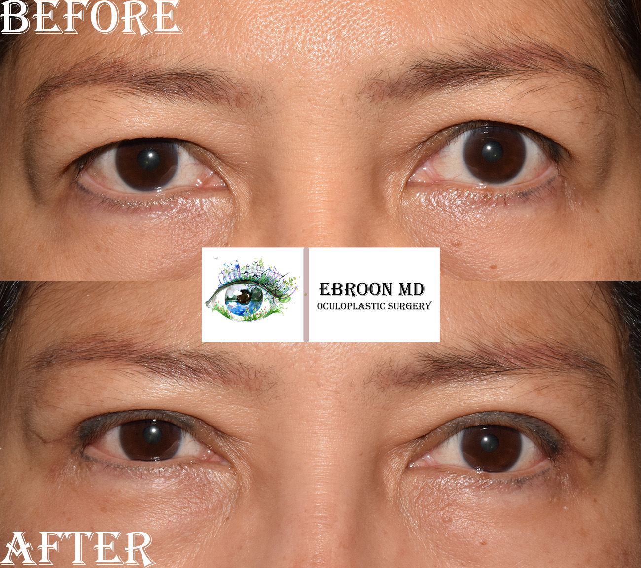 Upper Blepharoplasty Photo