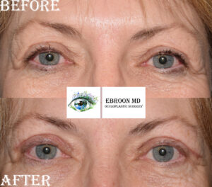 Upper Blepharoplasty Photo