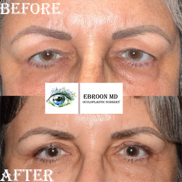 Upper Blepharoplasty Photo