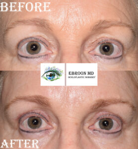 Upper Blepharoplasty Photo