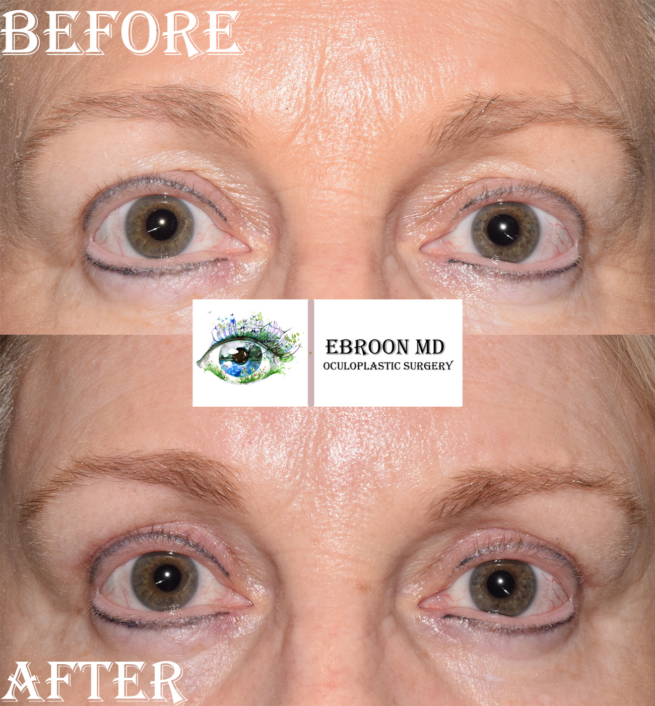 Upper Blepharoplasty Photo