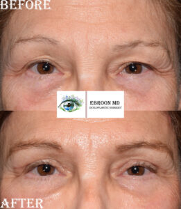Upper Blepharoplasty Photo