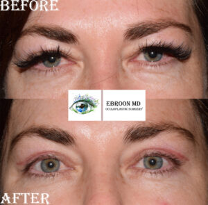 Upper Blepharoplasty Photo