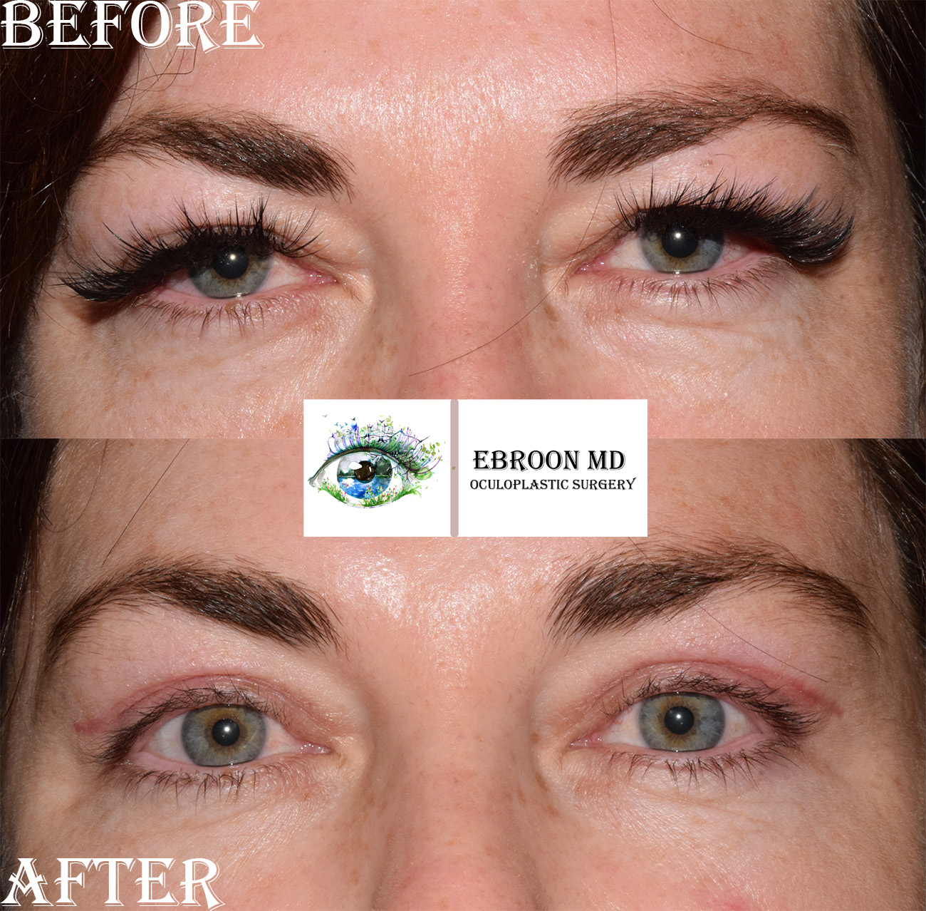 Upper Blepharoplasty Photo