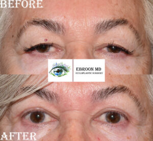 Upper Blepharoplasty Photo