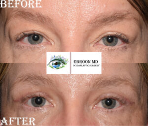 Upper Blepharoplasty Photo