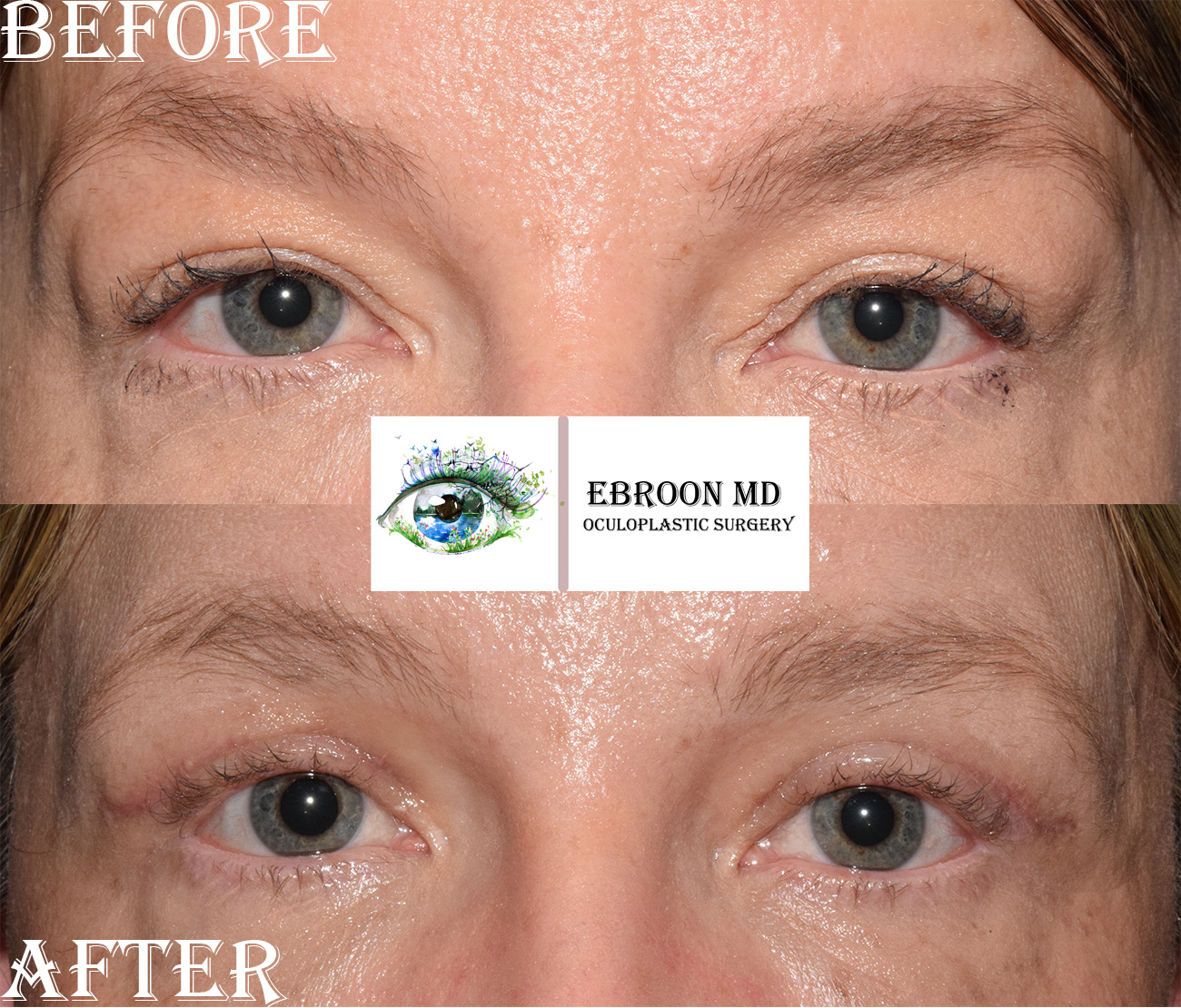 Upper Blepharoplasty Photo