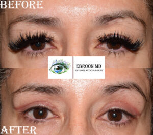 Upper Blepharoplasty Photo