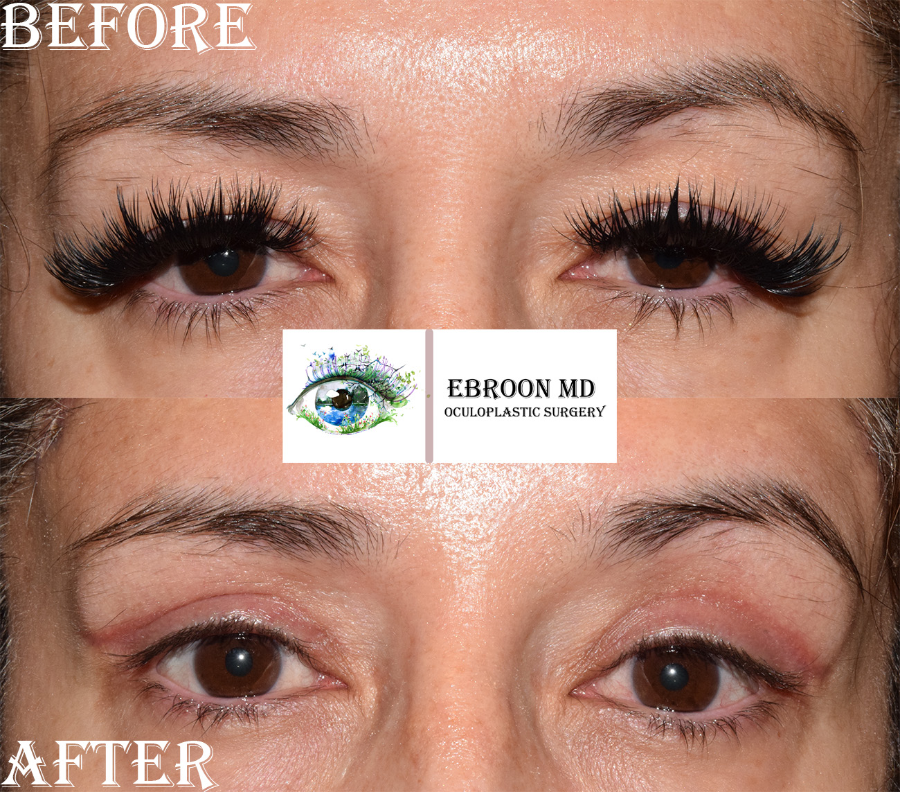 Upper Blepharoplasty Photo