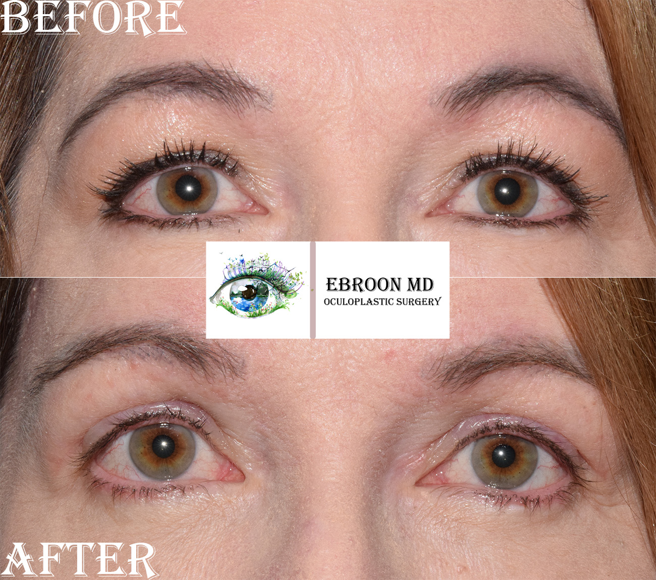 Upper Blepharoplasty Photo