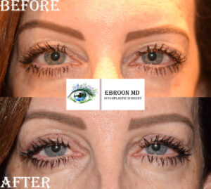 Upper Blepharoplasty Photo
