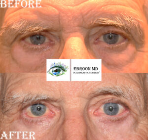 Lower Eyelid Blepharoplasty
