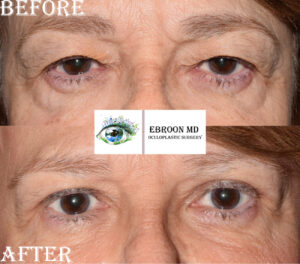 Upper and Lower Blepharoplasty