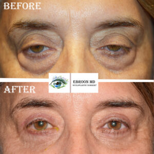 Upper and Lower Blepharoplasty
