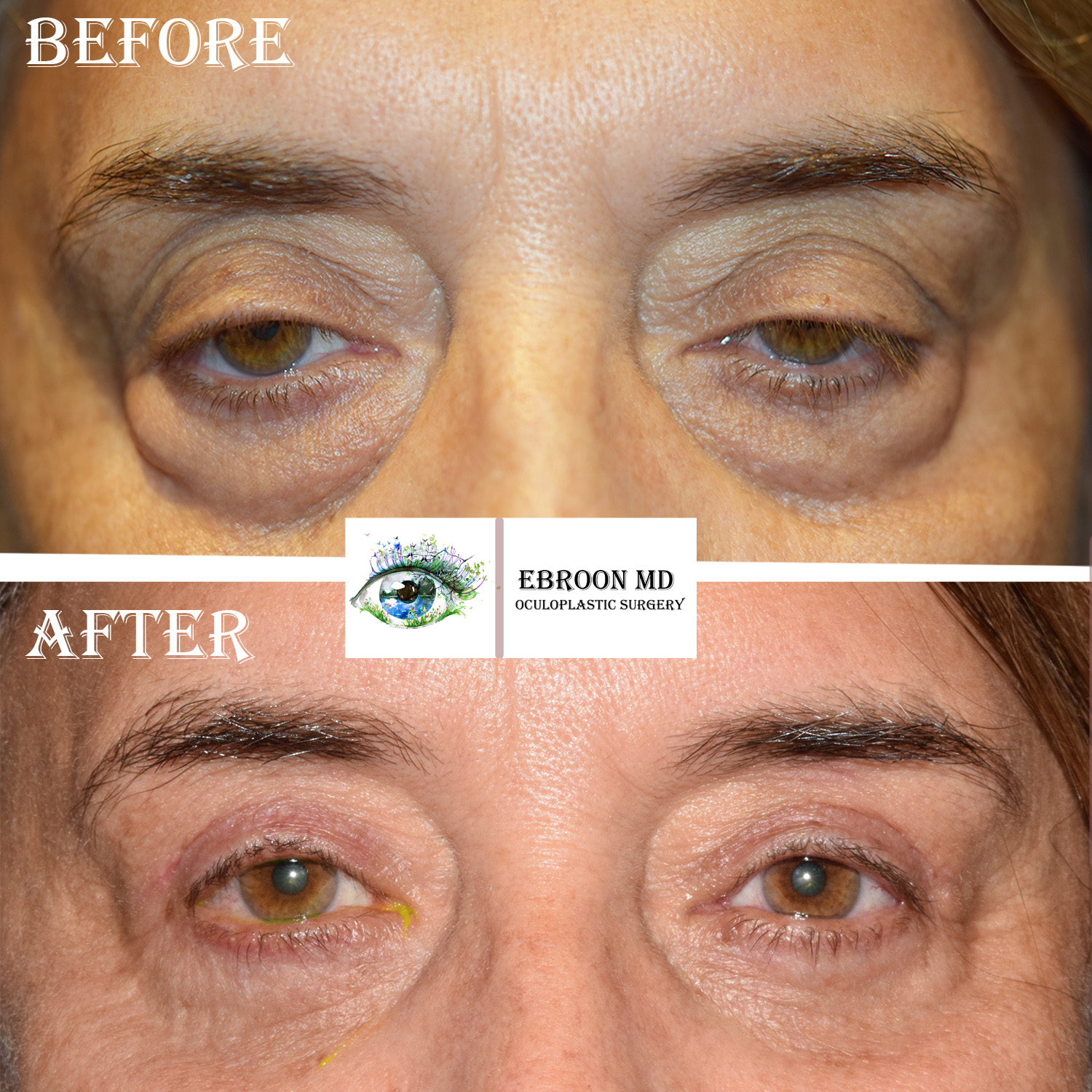 Upper and Lower Blepharoplasty