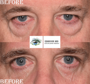 Lower Blepharoplasty