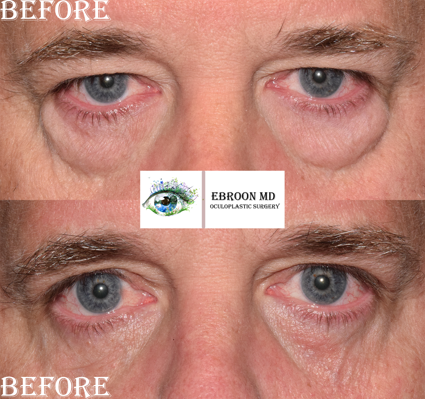 Lower Blepharoplasty