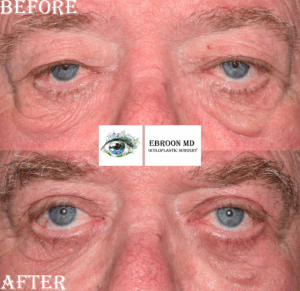 Lower Blepharoplasty