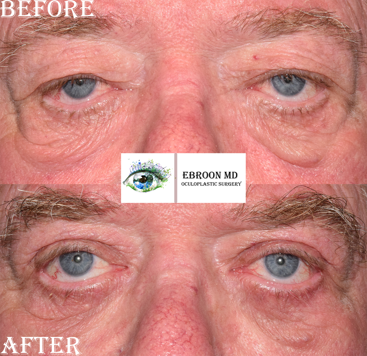 Lower Blepharoplasty