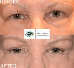 Lower Blepharoplasty