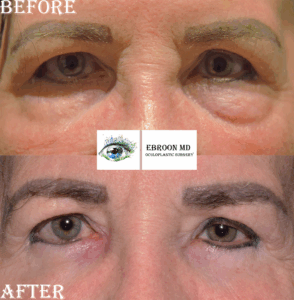Lower Blepharoplasty