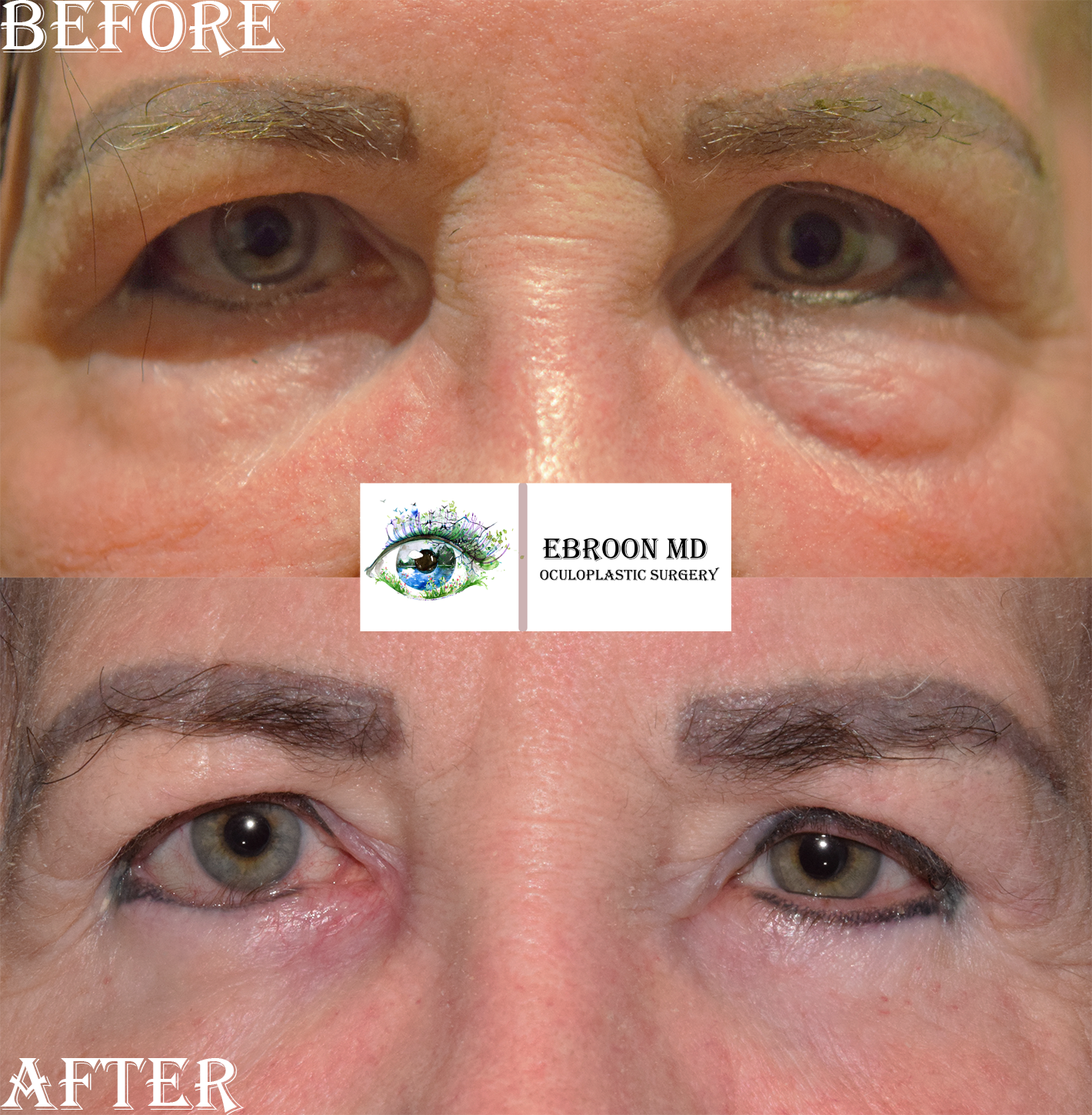 Lower Blepharoplasty