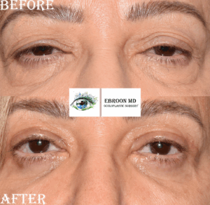Lower Blepharoplasty