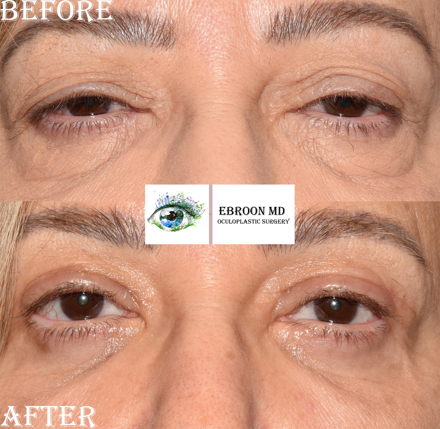 Lower Blepharoplasty