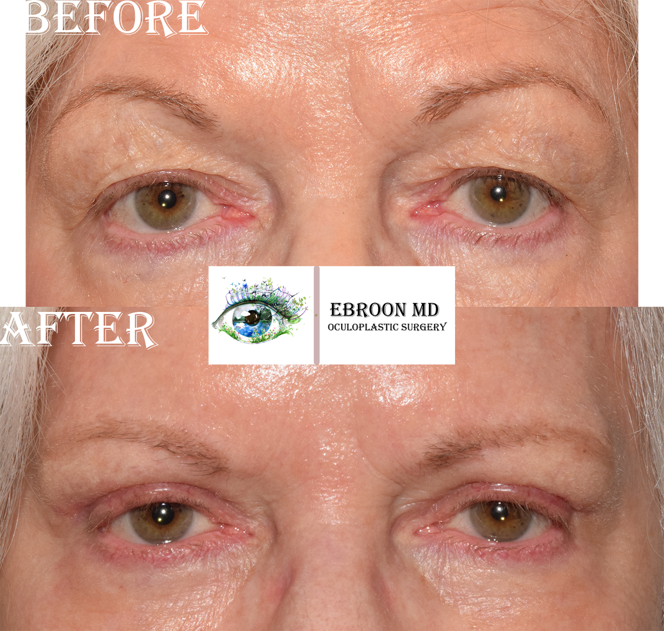 Lower Blepharoplasty
