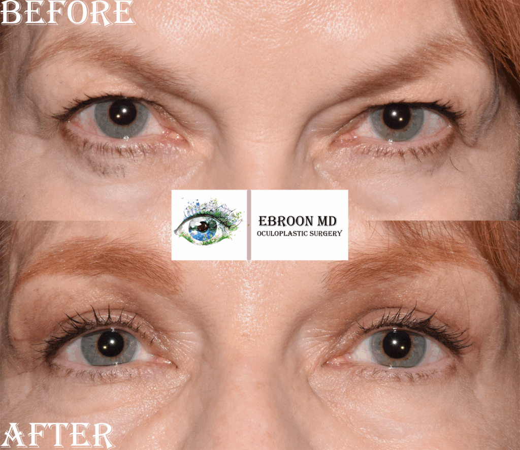 Lower Blepharoplasty