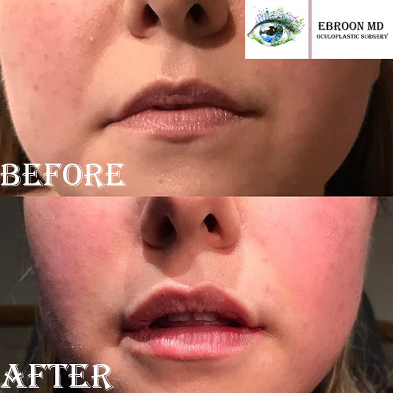 Cosmetic Filler Photo Cosmetic Filler Photo