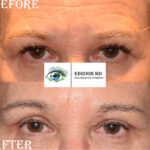Browlift and Upper Bleph