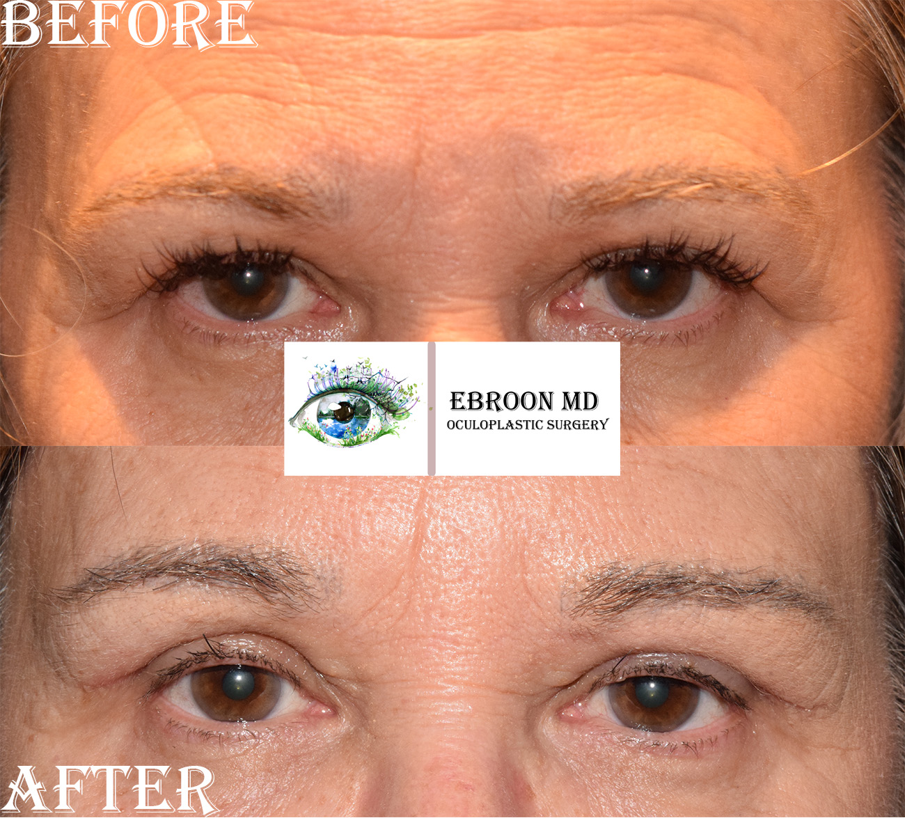 Browlift and Upper Bleph