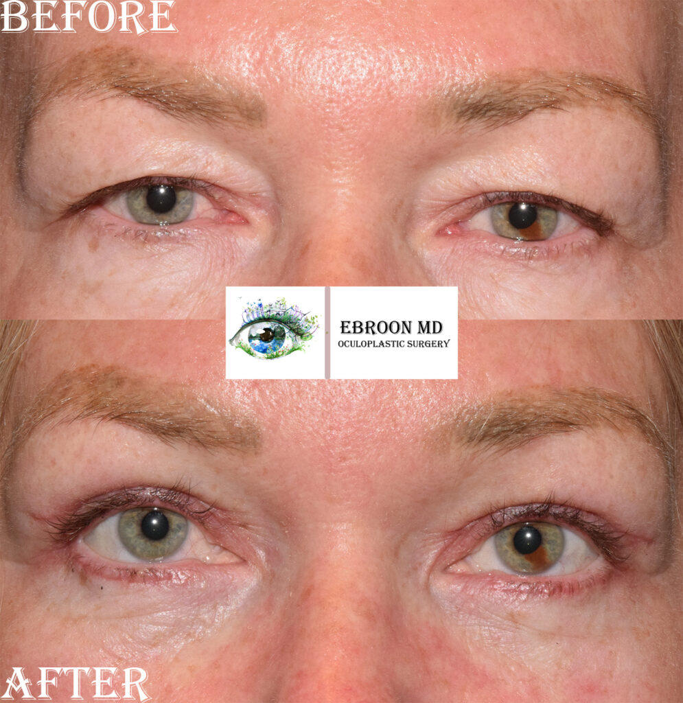 Upper Eyelid Bleph