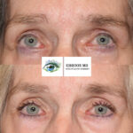 Browlift and Upper Bleph