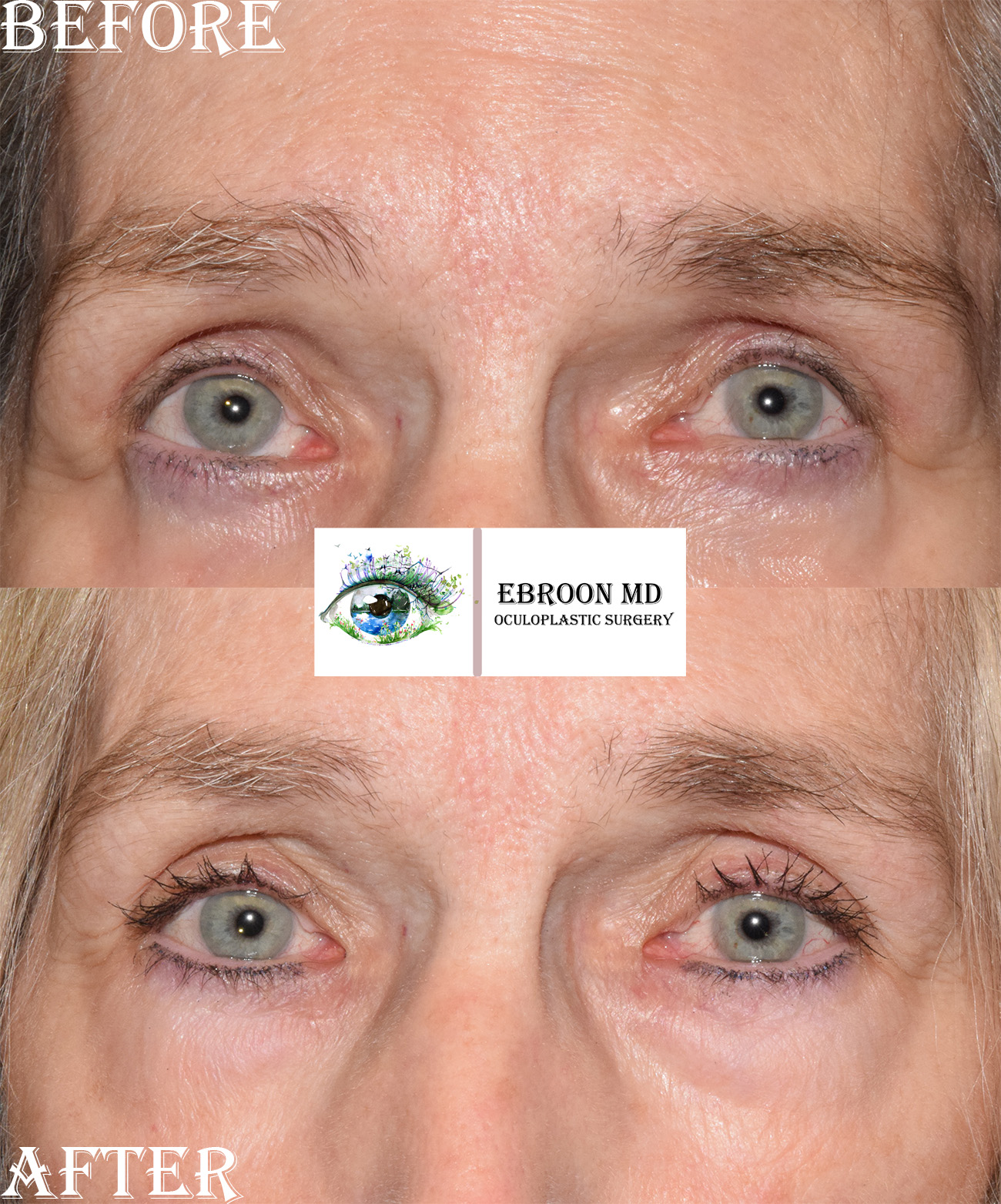 Browlift and Upper Bleph