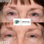 Browlift and Upper Bleph