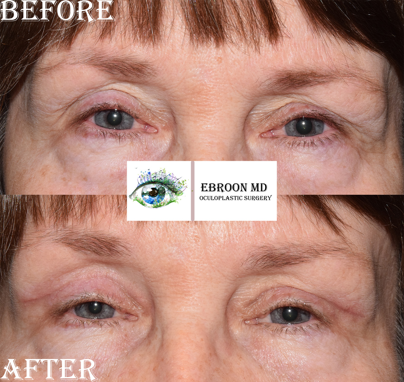 Browlift and Upper Bleph