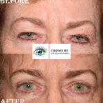 Browlift and Upper Bleph