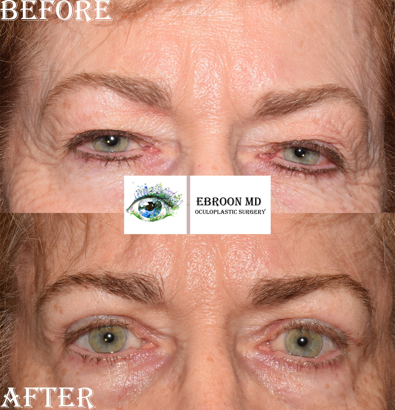 Browlift and Upper Bleph