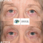 Browlift and Upper Bleph