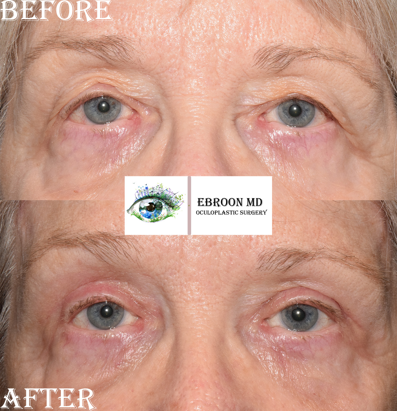Browlift and Upper Bleph