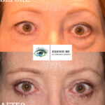 Browlift and Upper and Lower Bleph