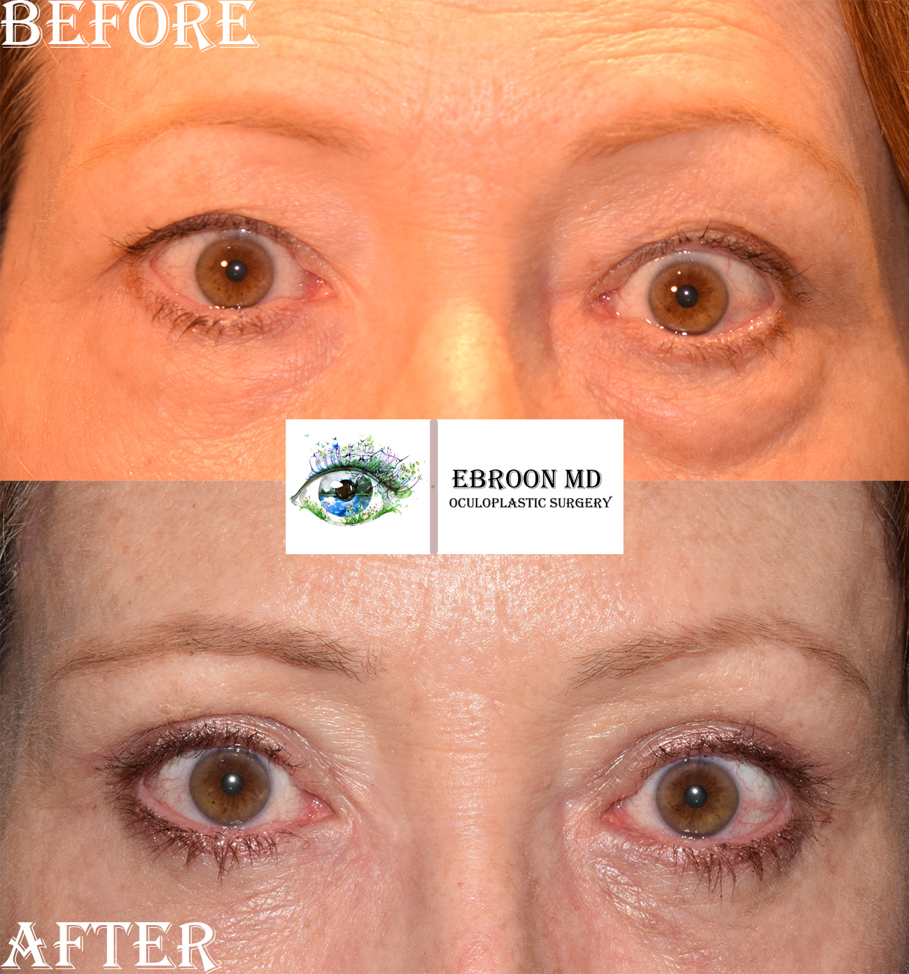 Browlift and Upper and Lower Bleph