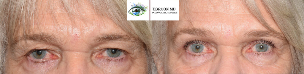 Temporal Browlift Photo