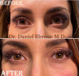 Before and After Restylane Photo